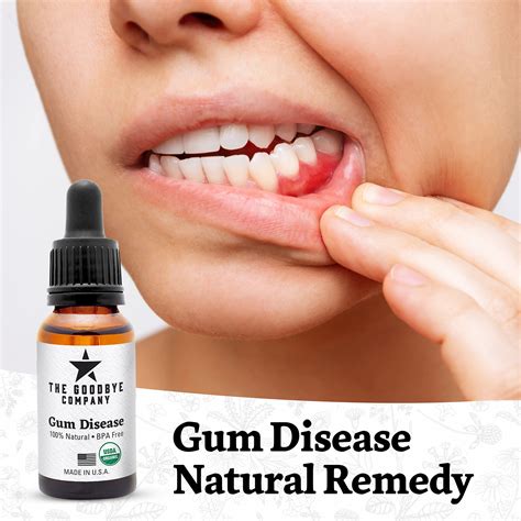 Home Remedies To Cure Gingivitis