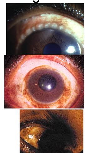 Episcleritis vs Scleritis Flashcards | Quizlet