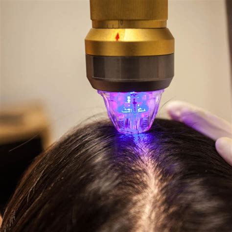 Iodoterapia Faz Cair O Cabelo - Tricologia: Quais são os melhores tratamentos para a queda de cabelo ...