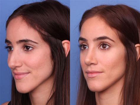 jewish nose jobs