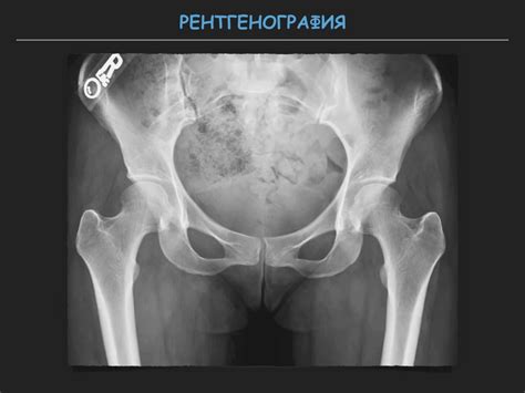 Визуализация тазобедренного сустава