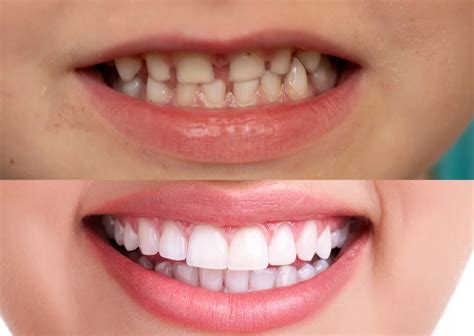 Diferencia entre Dientes de Leche y Definitivos - Clínica Dental Everest