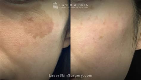 levisa lazer: Before & After Photos That Will Amaze You - vj1xwk6