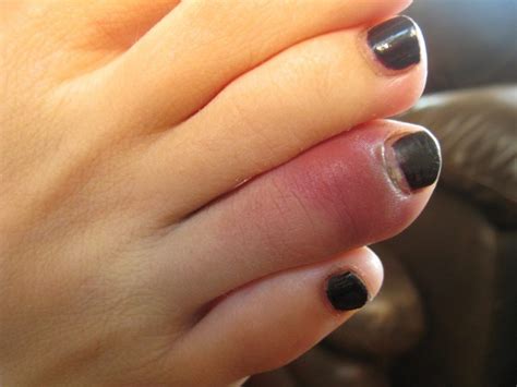 broken toe artofit
