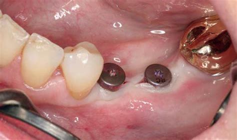 vertical defect   posterior mandible  teeth gap geistlich