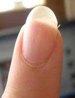 Eggshell Nails - Treatment of Eggshell Nails - Nails Become Fragile ...