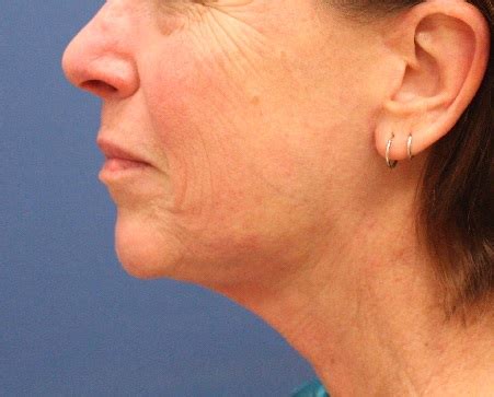 Chin Augmentation Case 4 - Cascade Facial Surgery and Aesthetics Mt. Vernon