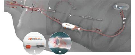 Major Breakthrough In Treatment Of Carotid Artery Disease: Vascular Specialists: Vascular Surgeons