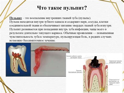 Пульпит. Классификация пульпита - презентация онлайн