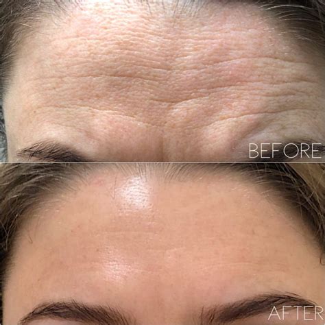 forehead-before-and-after-1024×1024 | Fibroblast Plasma Pen