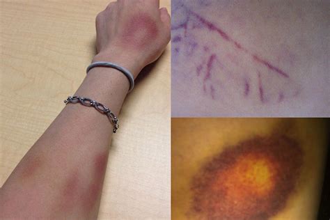 characteristics  bruises godoy medical forensics