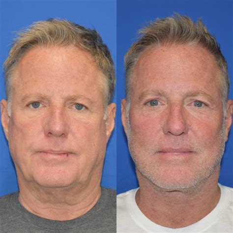 extended deep plane facelift  men austin tx dr indeyeva