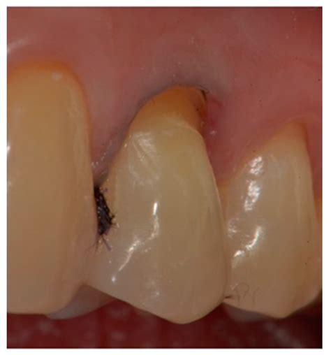 Clinical Behavior of the Gingival Margin following Conservative