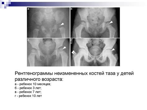 Костный возраст - презентация онлайн