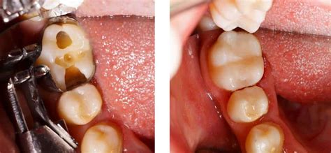 Composite Filling before and after 3