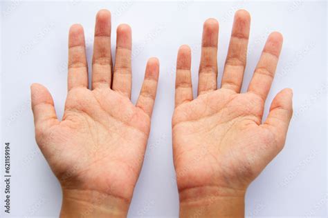 dengue fever rashes  hands isolated  white background stock photo