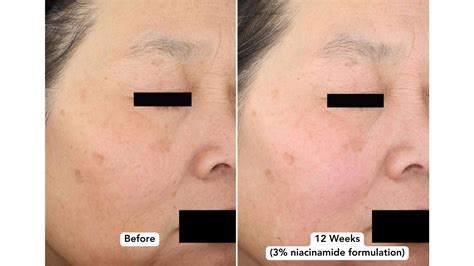 niacinamide  dark spots    detroit chinatown