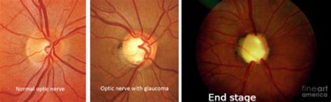 normal vs abnormal ocular pathology Flashcards | Quizlet