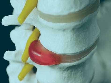 how to get a slipped disc back into place 1