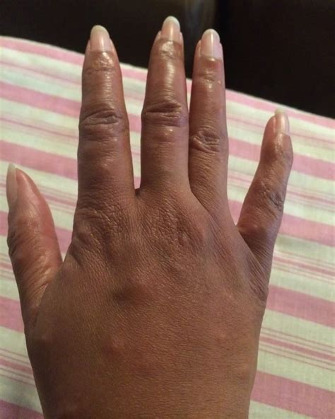 Bed Bug Bites On Black Babies