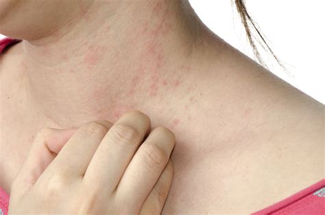 Intolerância A Lactose Pele - Sintomas da intolerância à lactose podem afetar a pele: 6 sinais mais ...