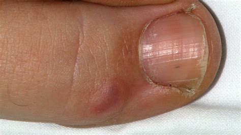 Bump Under Foot