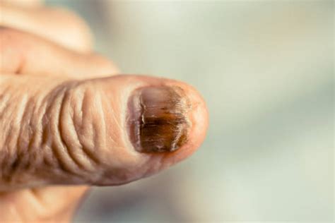 Uñas Enfermas - Banco de fotos e imágenes de stock - iStock