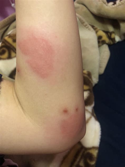 Carpet Beetle Allergic Reaction July 2018 Client Newsletter | No Blog