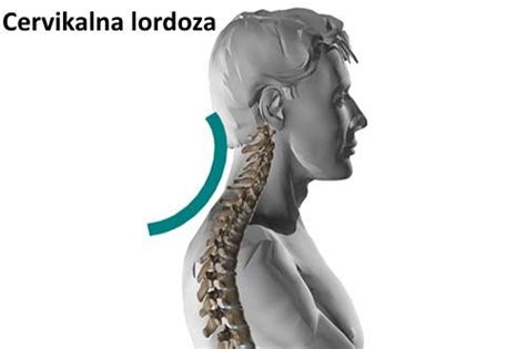 Lordoza: Vrste lordoze