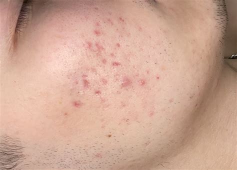 Прыщи на плечах и щеке На щёках и плечах прыщи, которые ни уходят ни ...
