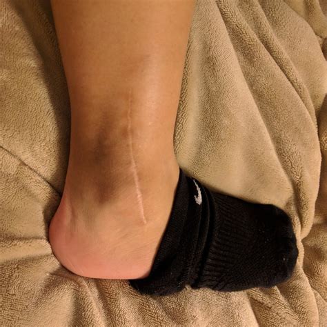 My Broken Ankle =(: 2017