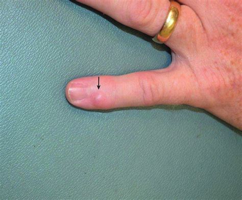 Image:Myxoid Cyst-Merck Manual Consumer Version