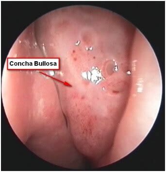 What is a Concha Bullosa – Ling Zhou, MD