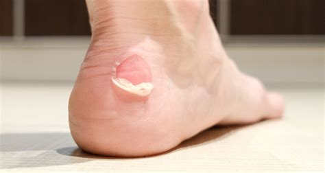 blisters  simple guide  treating  preventing