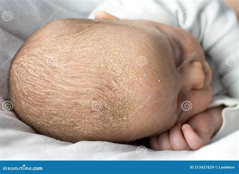 Seborrheic Dermatitis Crusts on the Baby`s Head. Child with Seborrhea ...