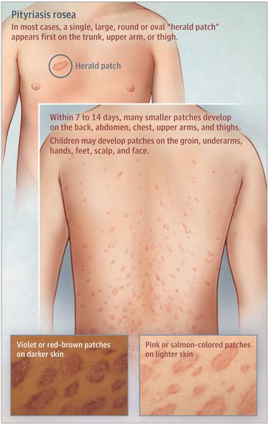 early pityriasis rosea mild