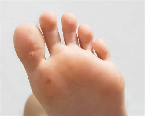 Everything you need to know about Verruca Pedis (Plantar Warts