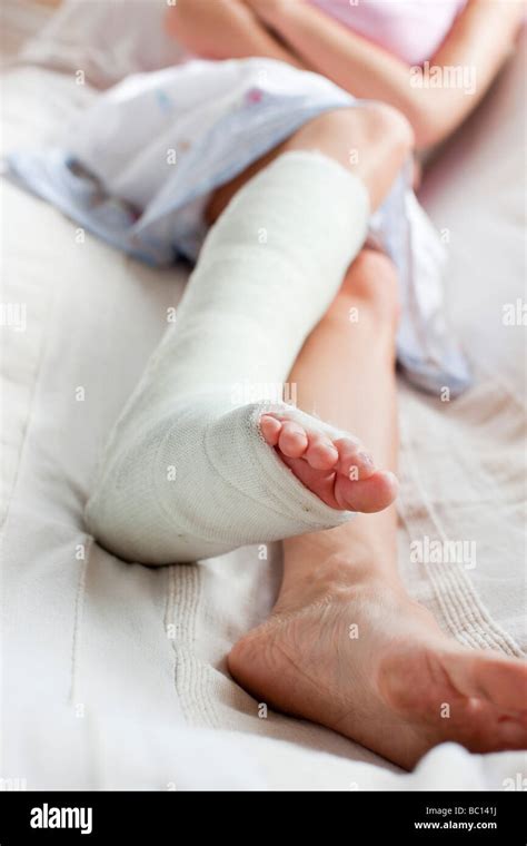 broken leg  res stock photography  images alamy