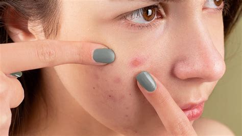 The Ultimate Guide to Helping Acne Scars Fade Quickly - Glowsly