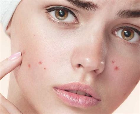 Have Acne Prone Skin? Here Are Some Things You Should Avoid Doing ...