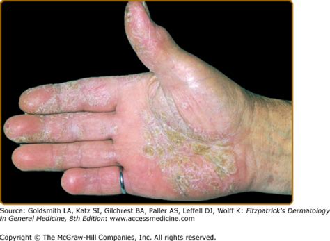 Vesicular Palmoplantar Eczema | Plastic Surgery Key