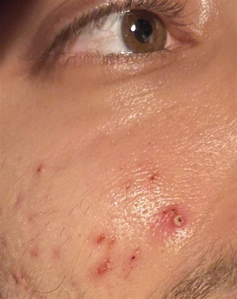 What Dermatologists REALLY Think About Unbelievable Blackhead Removal 2024! Image 8