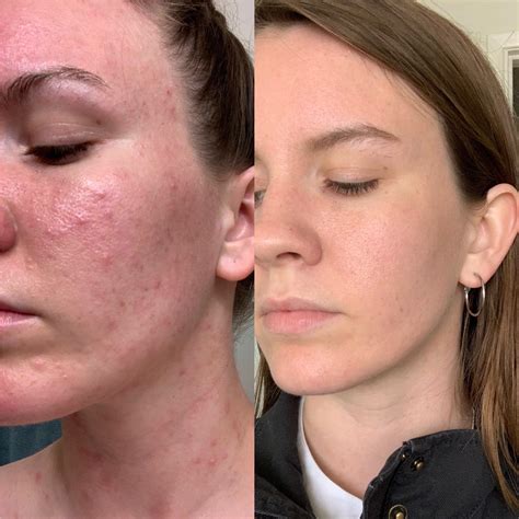 Dermatitis On Face How To Treat at Kim Jean blog