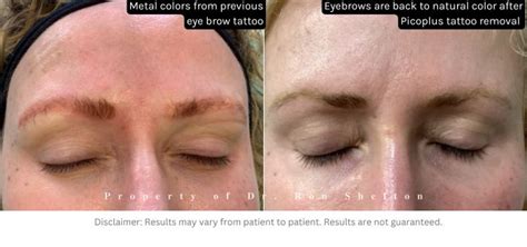 PicoSure Laser Tattoo Removal NYC | Remove tattoos NYC