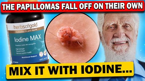 The best recipes for fighting papillomas and warts! That's exactly what ...