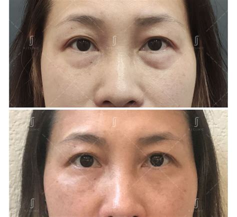 rj laser eye bag removal rj clinic