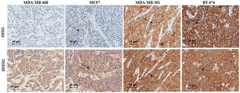 ihc analysis  tumor tissue extracted    breast tumor