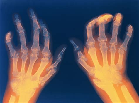 Rheumatoid Arthritis Blood Work Up at Melvin Schilling blog
