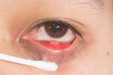 Stye Treatment Adults at Olivia German blog
