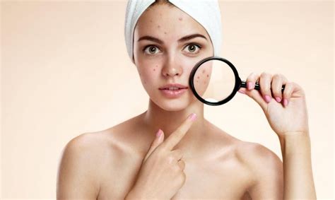 Современные и эффективные методы борьбы с акне и постакне - Blog BS Clinic
